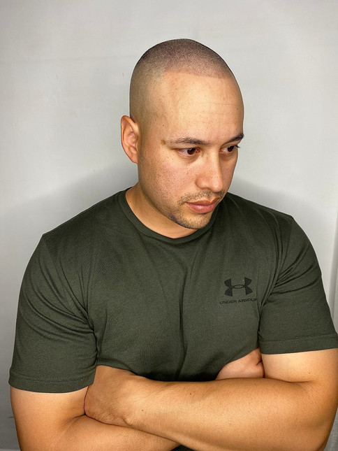SMP result - soft hairline restoration