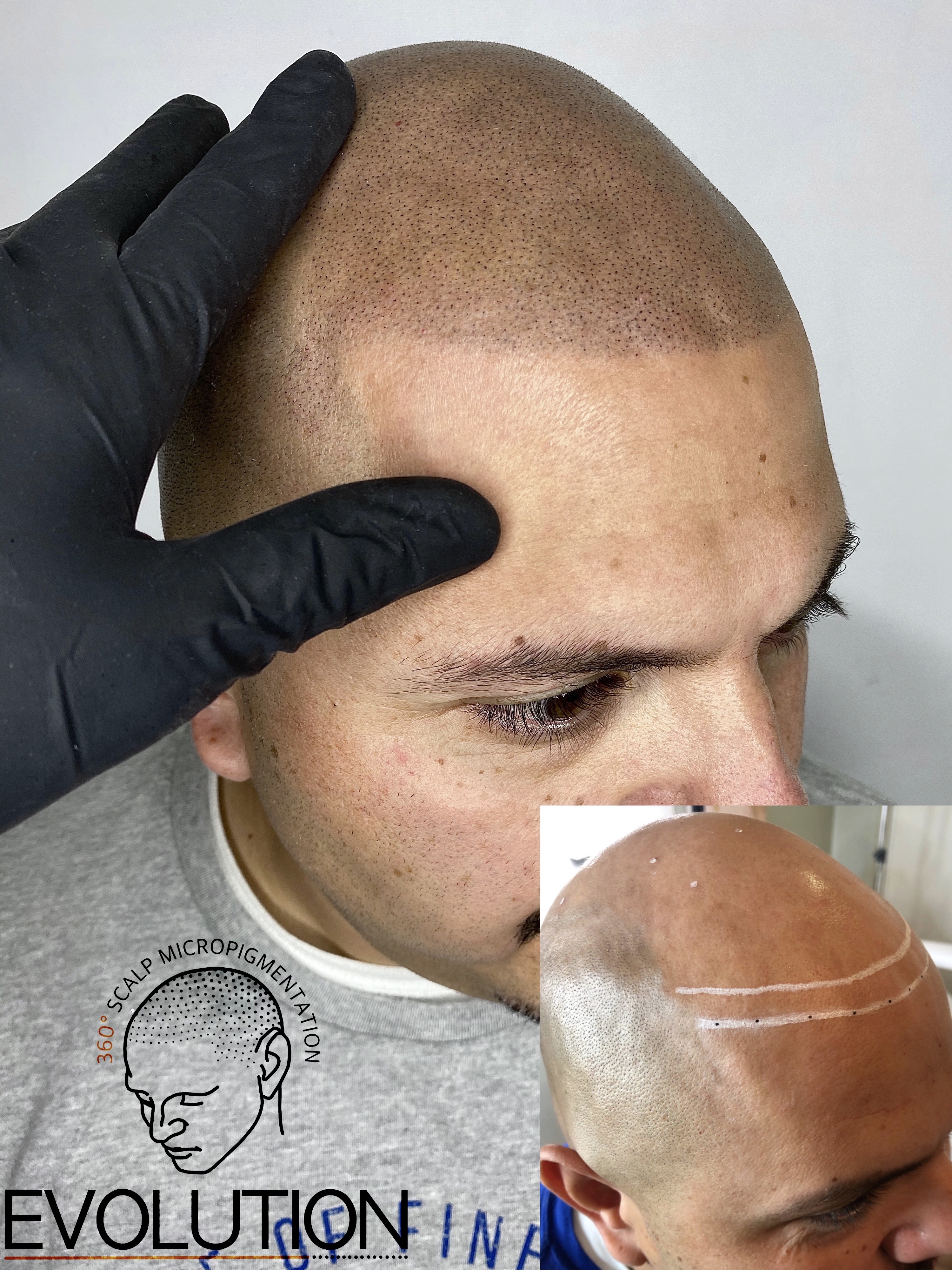 SMP result - full hairline